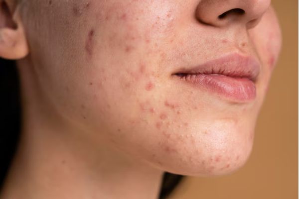 acne kaise hataye
