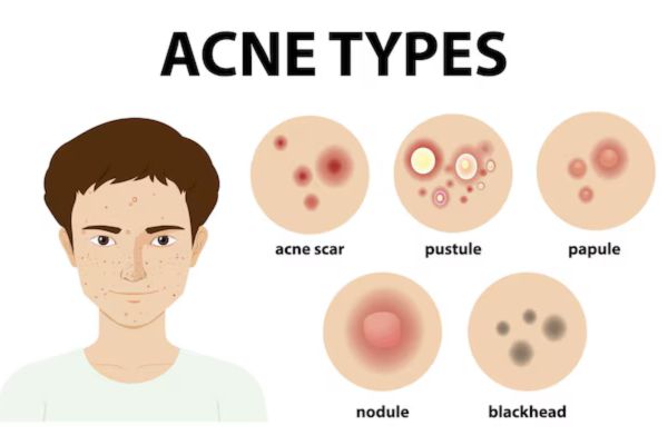 Chehre Se Acne Kaise Hataye