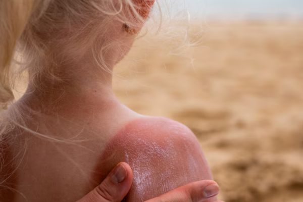 Sunburn ka ilaj at home: धूप से झुलसी त्वचा के लिए आसान घरेलू उपाय
