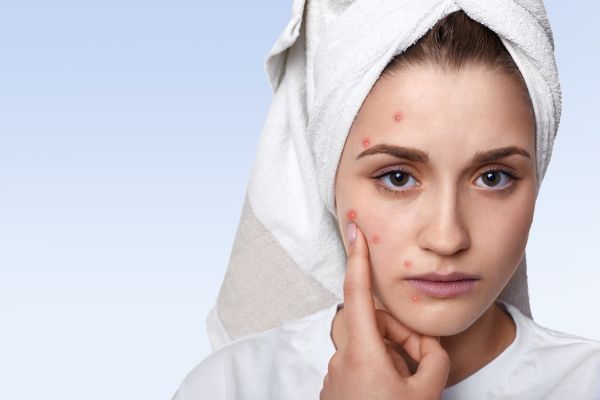 Monsoon Skin Care Home Remedies